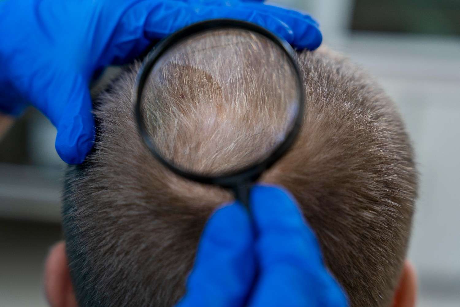 Mole on Scalp