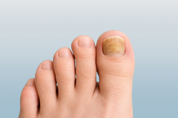 Close-up of a toenail affected by fungal infection